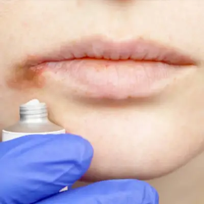 herpes-labial-causas-y-tratamientos/Image-2